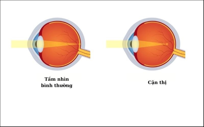 can-thi-la-gi-Kinh-Mat-Binh-An1